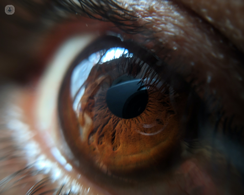 A close of up of brown eye that may need selective laser trabeculoplasty