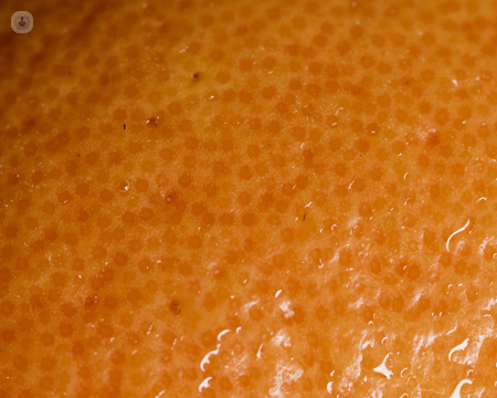Close up of orange peel that looks like skin treated by mesotherapy