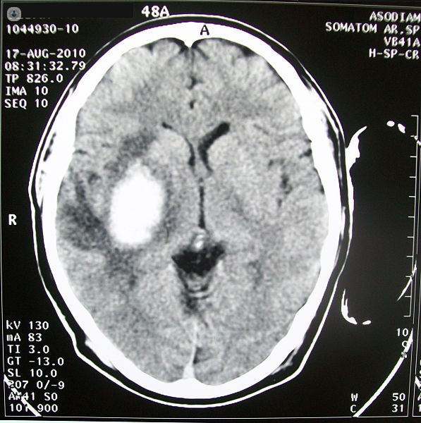 CT scan of an intracranial hematoma