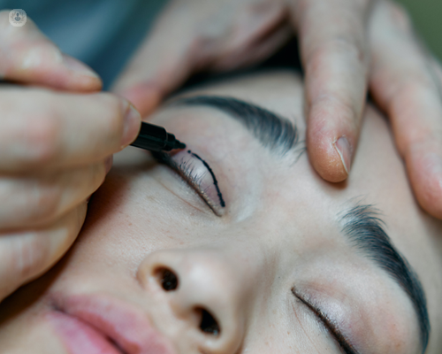 Young woman undergoing a blepharoplasty procedure on her upper eyelid