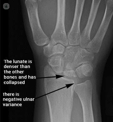 An x-ray scan of a hand which is showing symptoms of Kienbock's disease. There is negative ulnar variance and the lunate bone is dense and has collapsed.