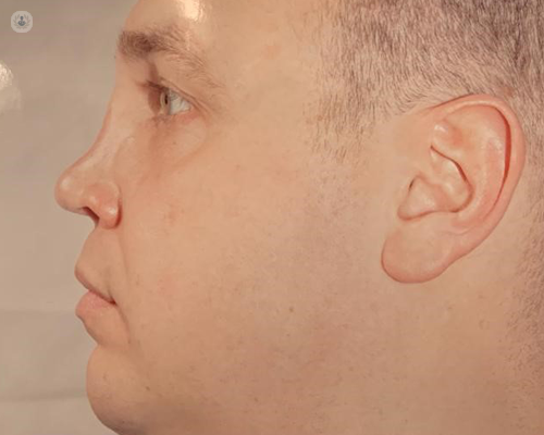 Before picture from the side, of a man with a pointed nose and who is to have a nose job