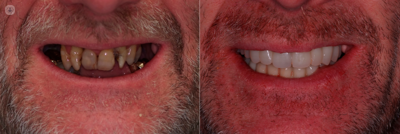 Before and after of patient who has had teeth in a day treatment