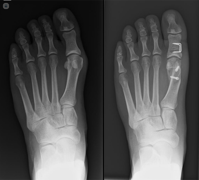 side by side X-ray scans of a foot pre and post bunion surgery