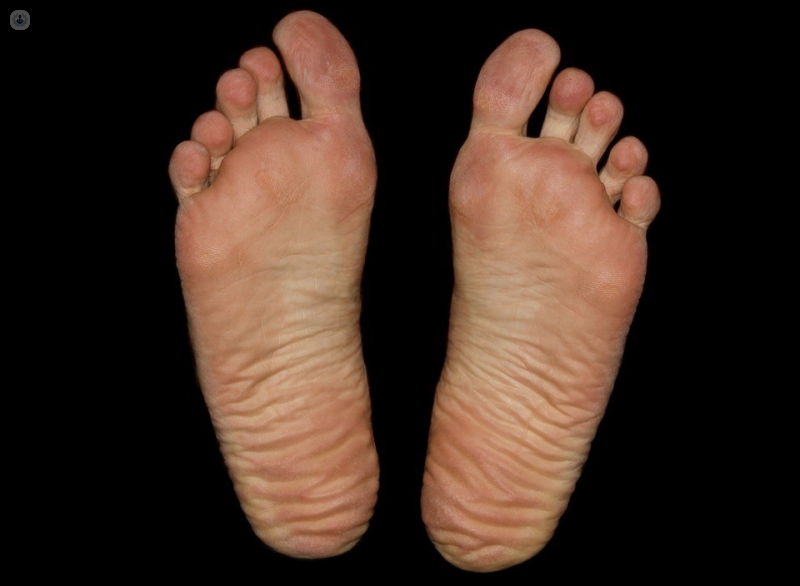 Image of flat feet