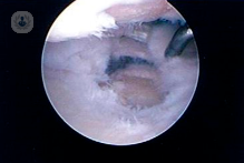 A large degenerative tear of the triangular fibrocartilage with associated osteoarthritis