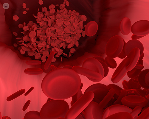 Blood cells travelling through the circulation system. Some blood cells are grouped together as a clot.