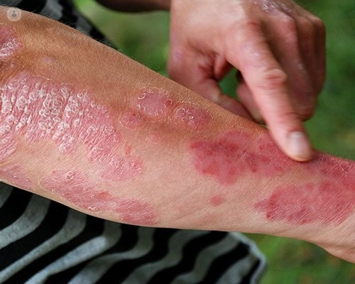 Arm with a red rash