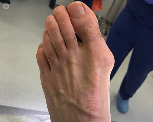 A photo of a foot with a bunion