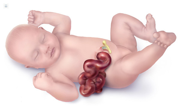 Illustration of newborn baby with a congenital abnormality