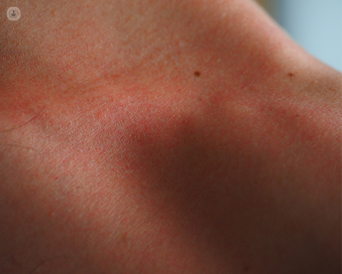 Red and irritated skin, which are possible signs of a skin allergy, on a person's collarbone.