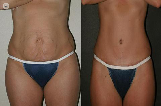 All about tummy tuck and non-surgical alternatives