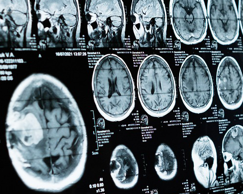 MRI scans of a brain, which can be a useful way to diagnose cerebral palsy