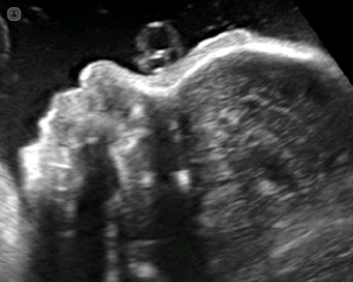 Image of foetal anomaly scan (18 - 24 weeks)
