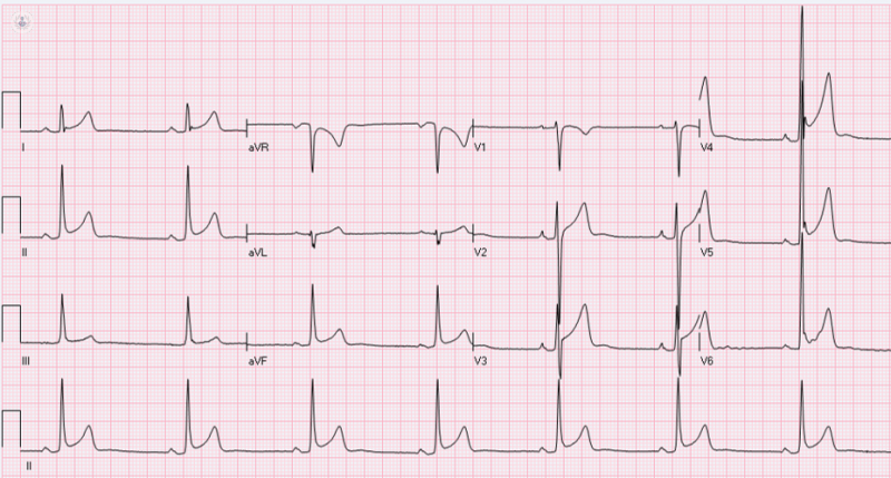 The results of an ECG, which is an electrical trace of the heart