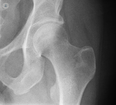 X-ray of a hip bone