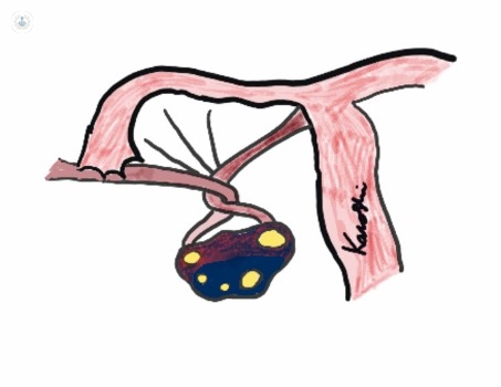 Figure 1 - Before laparoscopic shortening of the ovarian ligament