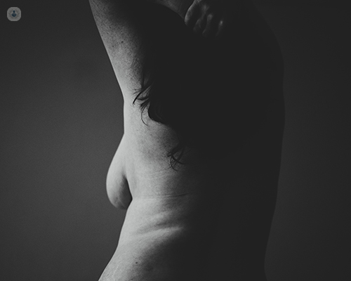 A woman's nude silhouette. Some women following having children or weight loss may choose to have breast lift surgery.
