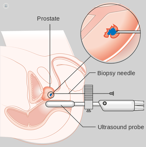 prostate biopsy plasturi maitan pentru prostatita