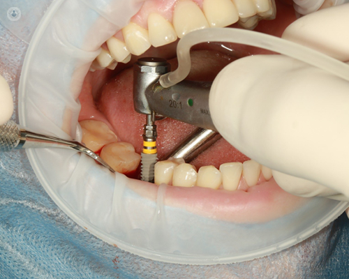 Dental implant being placed after bone reconstruction