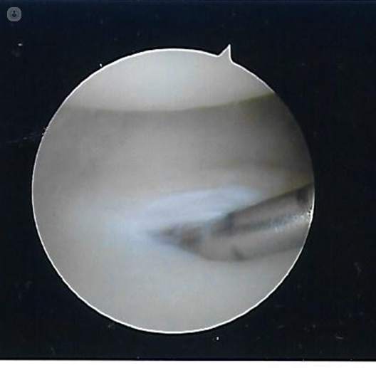 A traumatic tear of the triangular fibrocartilage with a metal probe inserted into the tear.