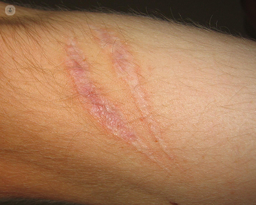 Scar Treatment How To Get Rid Of Prominent Scarring