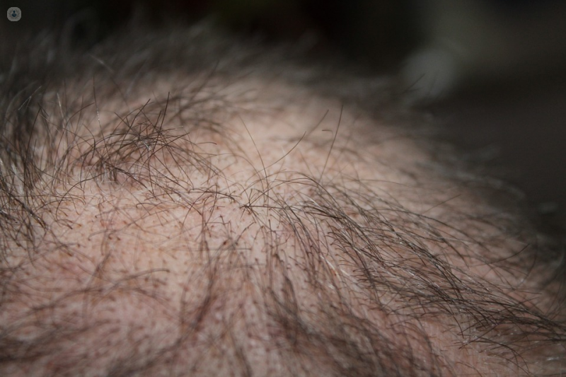 Hair loss: an expert's guide