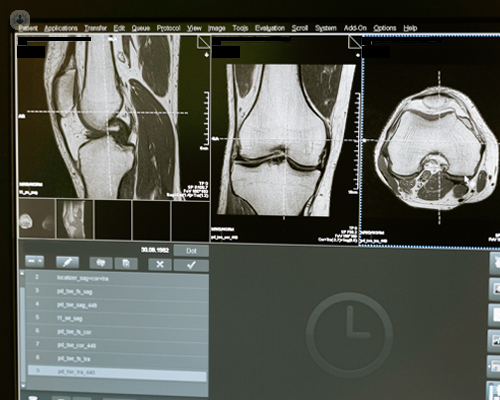 Computer screen showing results of a knee X-ray