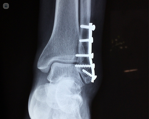 An x-ray scan of an ankle with surgical inserts to treat a fracture