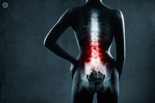 Spinal Cord Stimulator for Treating Chronic Back Pain