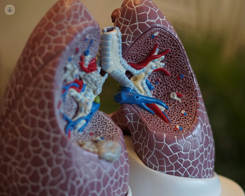 Lungs can be affected by brochiectasis
