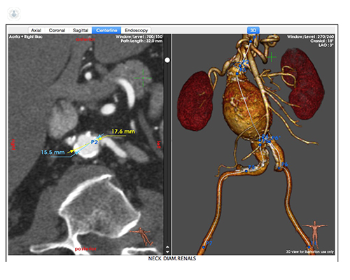 abdominal aortic aneurysm scan