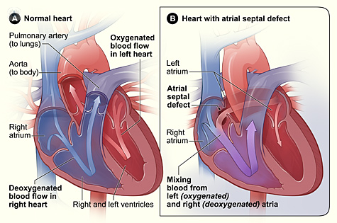 Diagram of a normal heart, and a heart with ASD