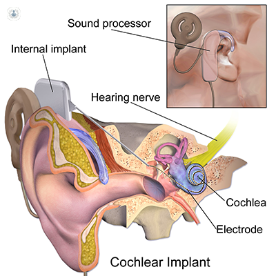 Diagram of how cochlear implants work 