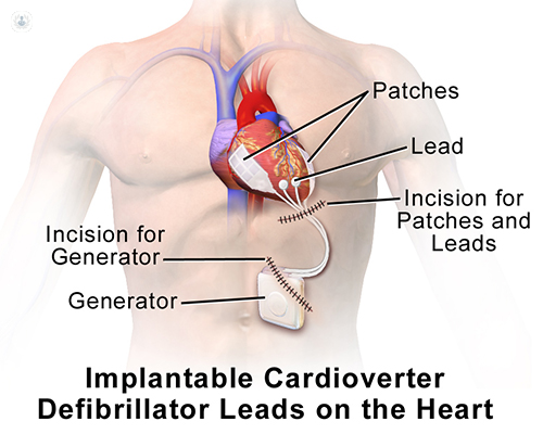 Cardioverter defibrillator for abnormal heartbeats |