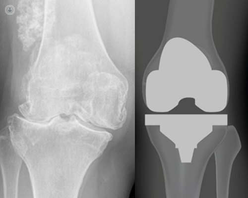 X-ray of a total knee replacement
