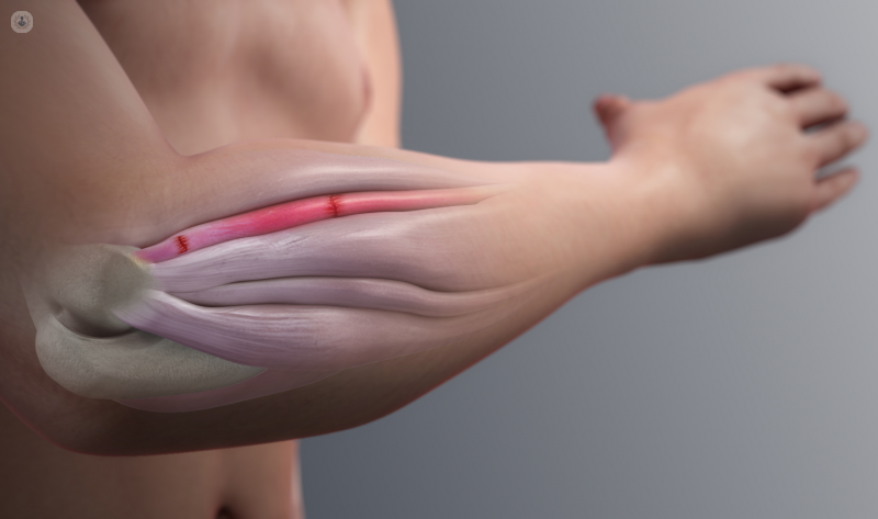 Digital illustration of arm, which can experience arm pain