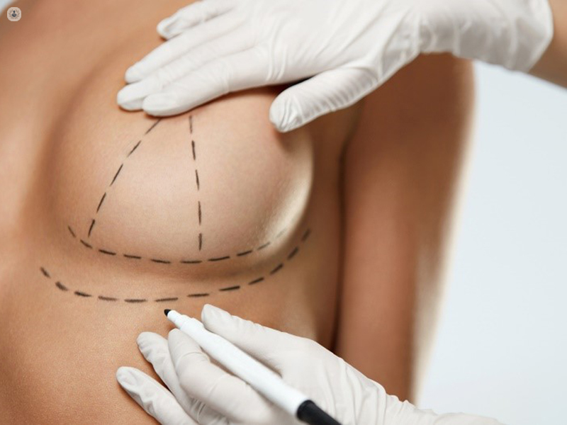 Tuberous Breast Correction - Chester