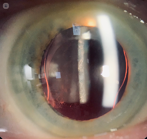 An close-up photo of a PCO-affected eye, taken by Mr Colin Vize.