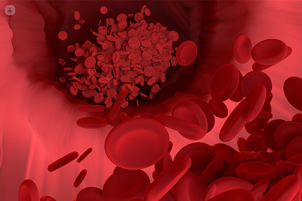 A digitalised image of a blood clot