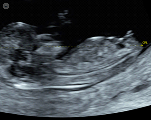 Image of Nuchal Translucency scan (11-14 weeks)